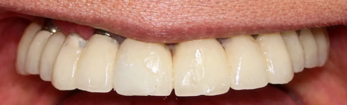 After All-on-6 dental implants