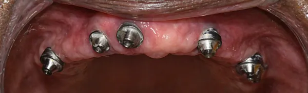 Treatment stage: six implants placed in the upper jaw