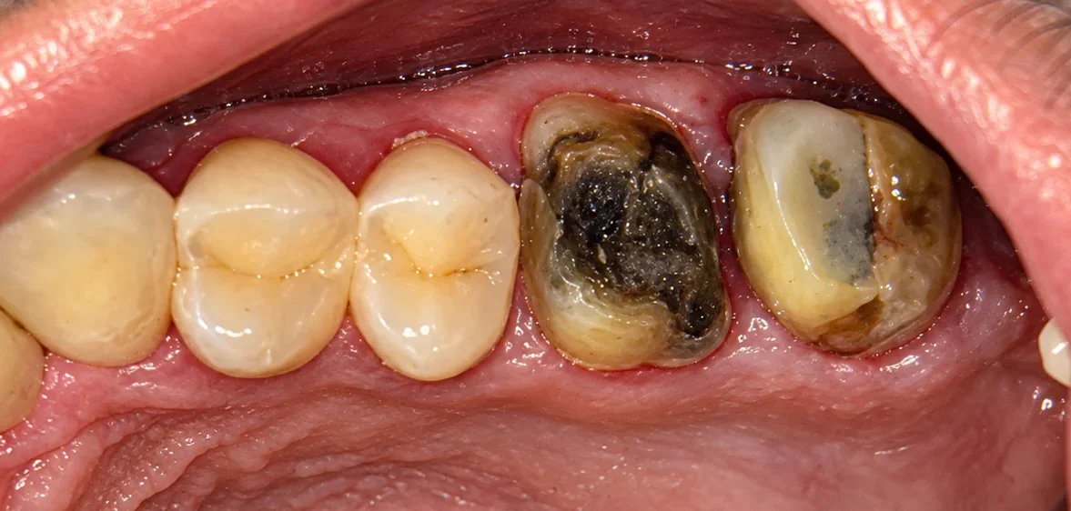 Before DMLS crowns for back teeth