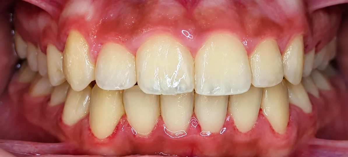 After Self-ligating braces
