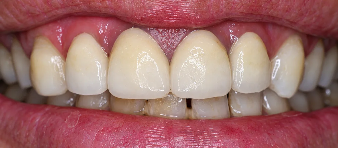 After Zirconia dental crowns