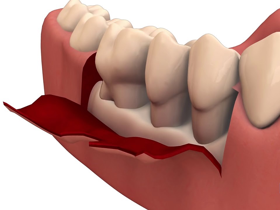 gum-treatment