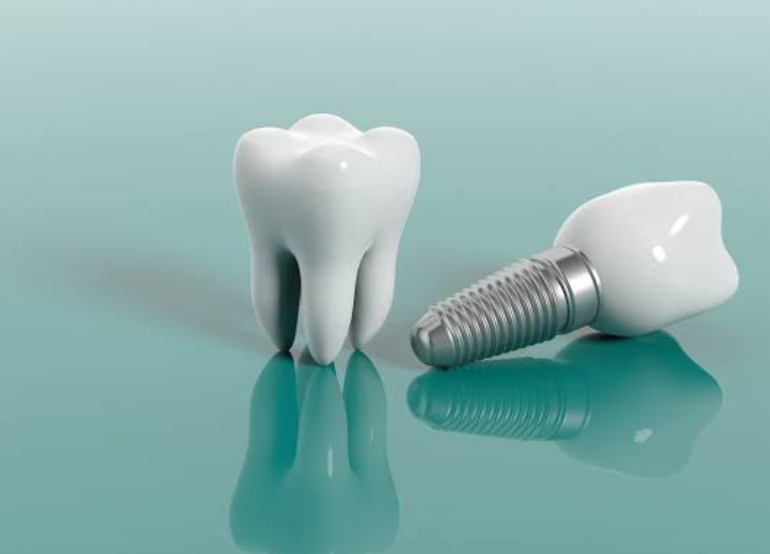 dental implant